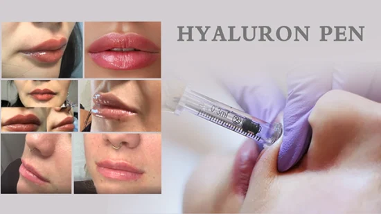 Chinese Supplier Factory Offer Buy Bouliga Brand Lip Breast Dermal Fillers Ha Injectable Hyaluronic Acid Filler Price